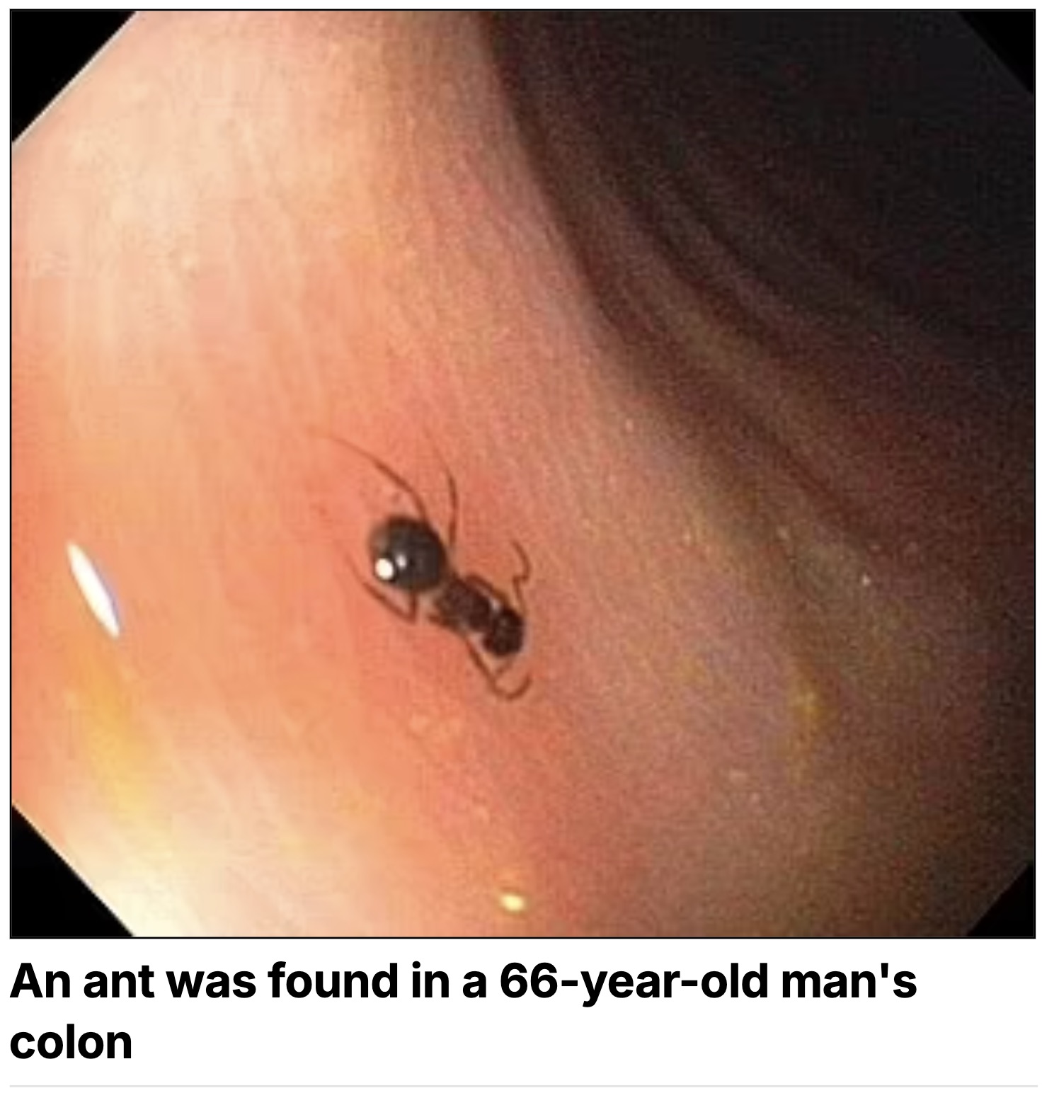 ladybug - An ant was found in a 66yearold man's colon